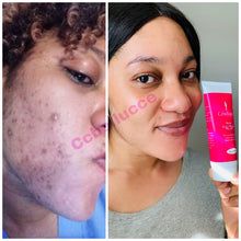 Load image into Gallery viewer, ACNE FACE WASH